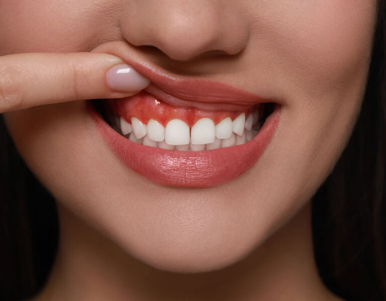 parodontoza-krwawienie-z-dziasel