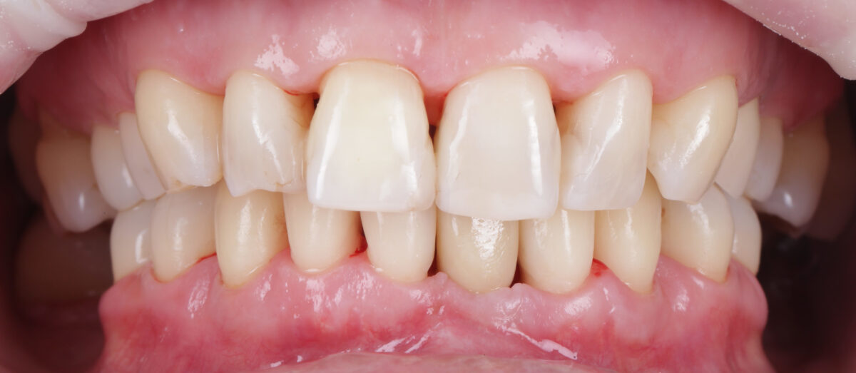 Paradontoza: poznaj przyczyny i dowiedz się, jak leczyć 9 paradontoza po
