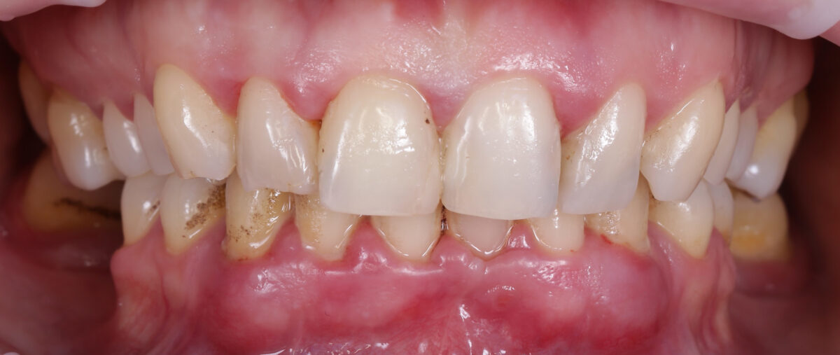 Paradontoza: poznaj przyczyny i dowiedz się, jak leczyć 8 paradontoza przed