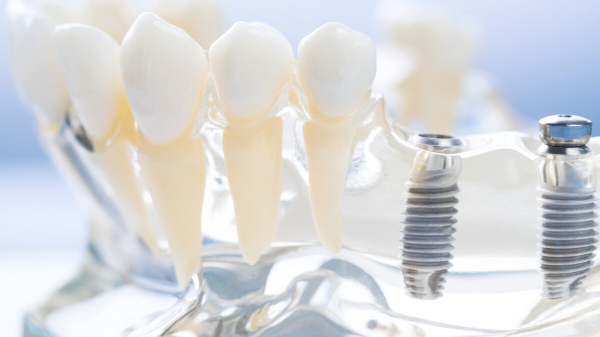 Czy warto inwestować w implanty zębów