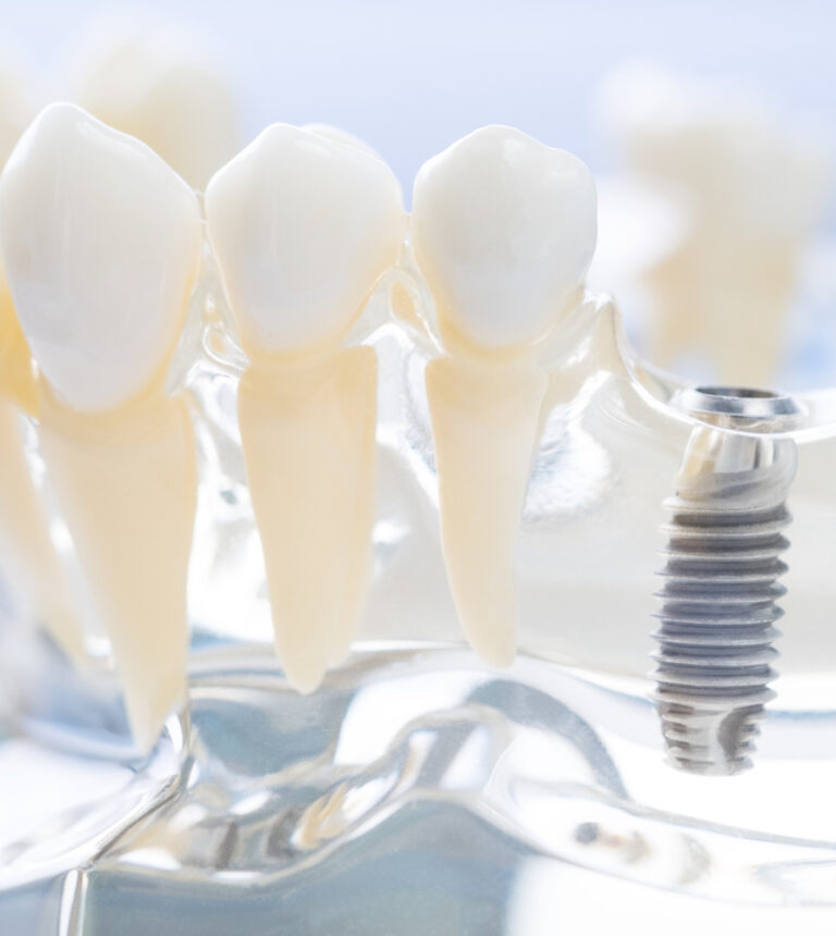 Czy warto inwestować w implanty zębów