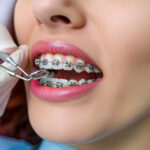 ile trwa zakładanie aparatu na zęby